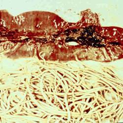 Adult Roundworms from small intestinal rupture in foal